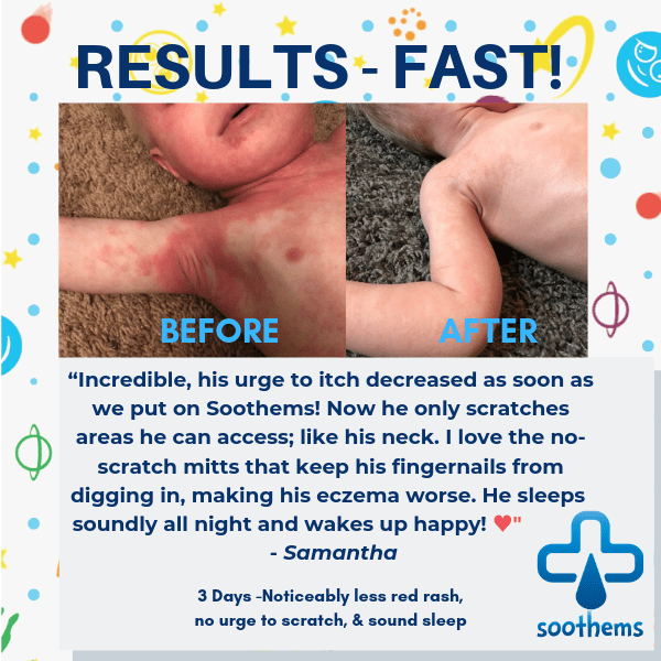 “Before And After Results using Toddler and children's Eczema Sleepwear and Wet Wrap Therapy”