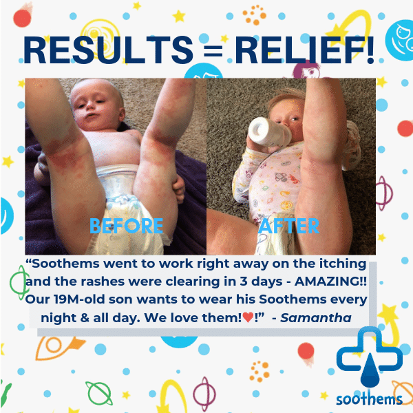 “Before And After Results using Baby Eczema Sleeves on the arms and legs as Wet Wrap Therapy”