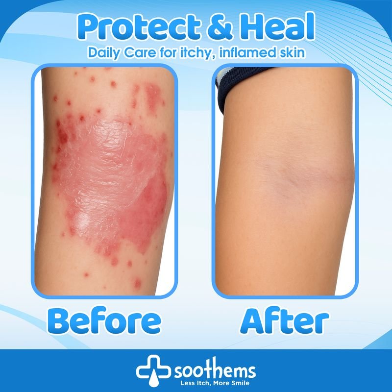 SoothemsKids Eczema Sleeves - White – Arm or Leg Sleeves for Eczema and Psoriasis Itch Relief | Good for Dry or Wet Wrap Therapy | Soothems®Apparel & Accessories > Clothing Accessories > Baby & Toddler Clothing AccessoriesSoothems