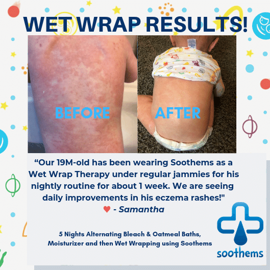 “Before and After Wet Wrapping Therapy Treatments wearing Baby Eczema Treatment Sleeves for babies elbows and knees”