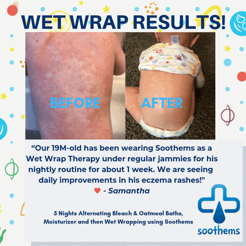 Eczema Sleeves for Children by Soothems For Elbows or Knees Soothems